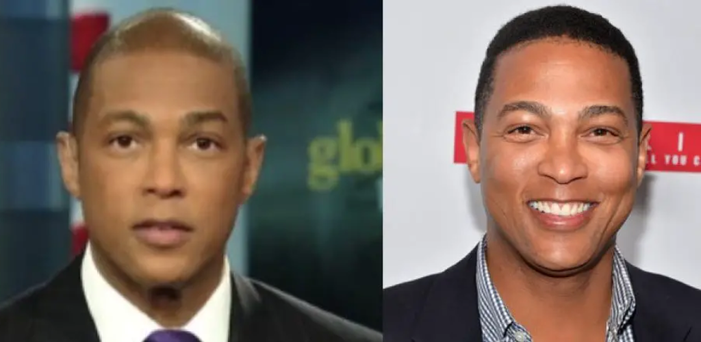 Don Lemon Hair Loss