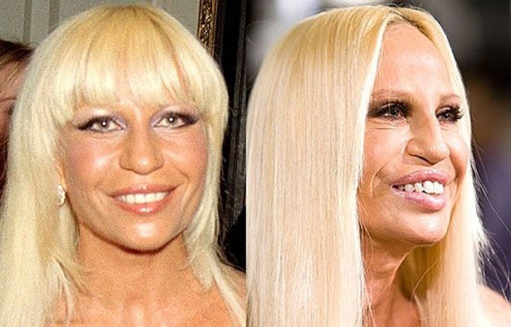 Donatella Versace Botched