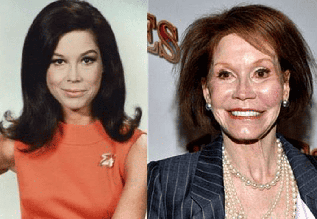 Mary Tyler Moore Nose Job