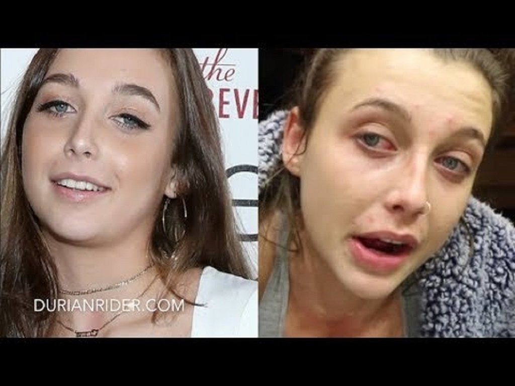 Emma Chamberlain Lip Fillers