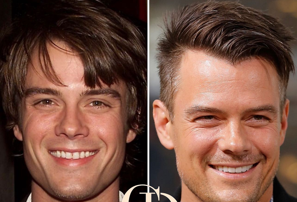 Josh Duhamel plastic surgery