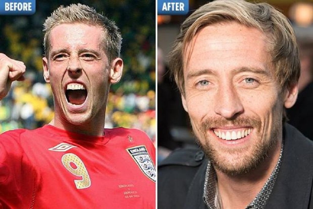 Peter Crouch Nose Job