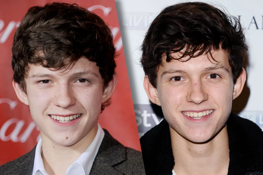 Tom Holland botox