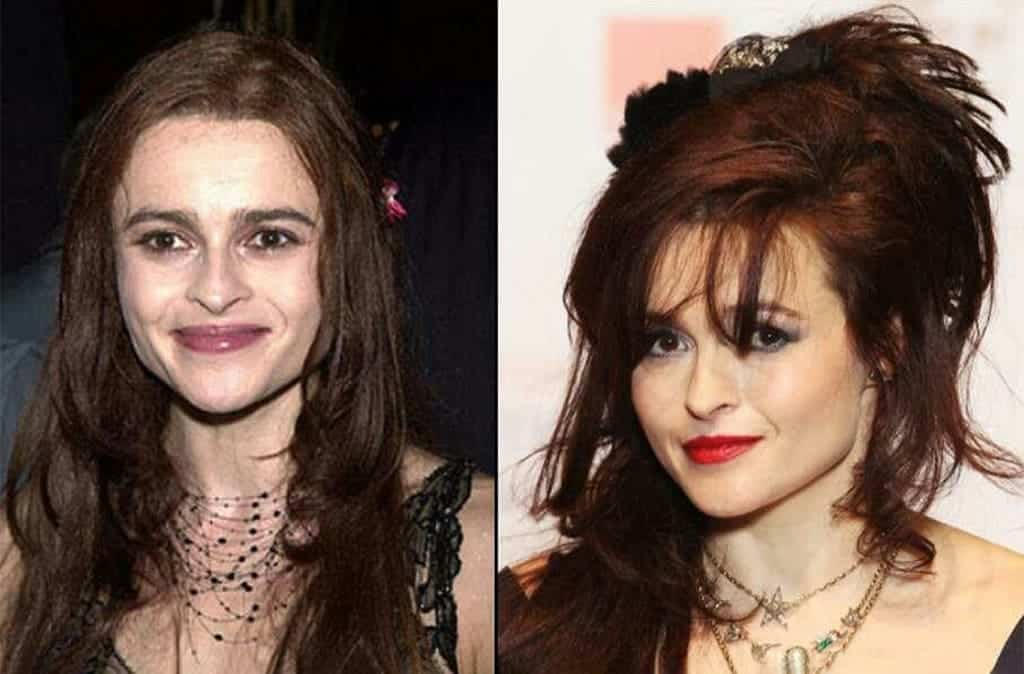 Helena Bonham Carter Surgery Before And After Photo