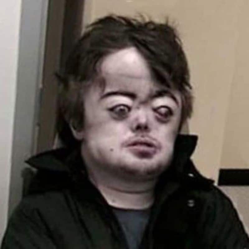 Brian Peppers Face: Brian Peppers had Apert syndrome.