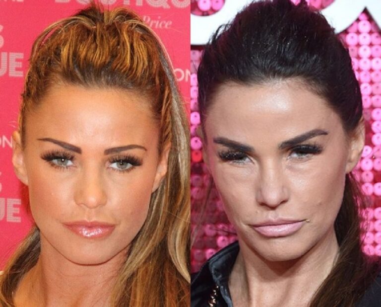 Katie Price Botched: What Happened To Her Lips? Before And After