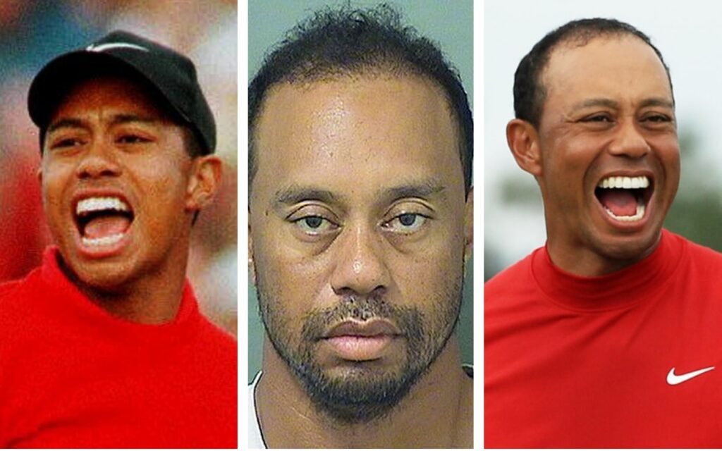 Tiger Woods Botox 